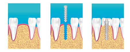 implant dentaire asnieres