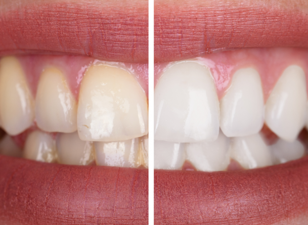 Comment faire face au jaunissement des dents : Guide complet pour un sourire éclatant