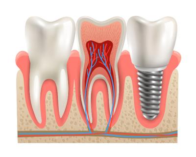 implant dentaire asnieres