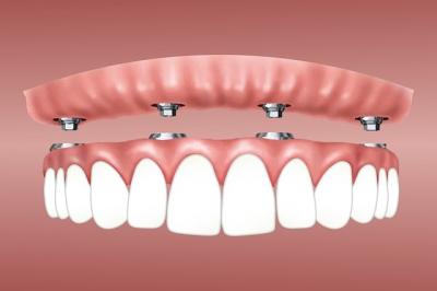 implant dentaire - dentiste asnieres